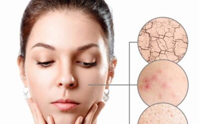 I tre problemi della pelle in primavera, ecco come risolverli